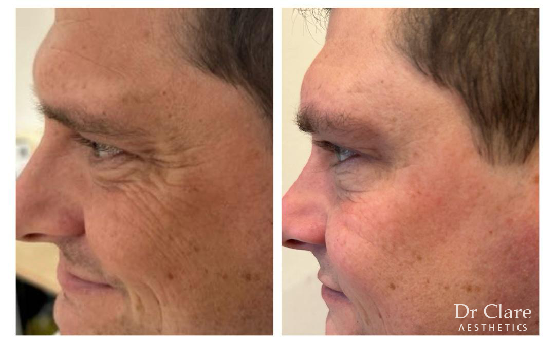Male crow's feet anti-wrinkle before and after