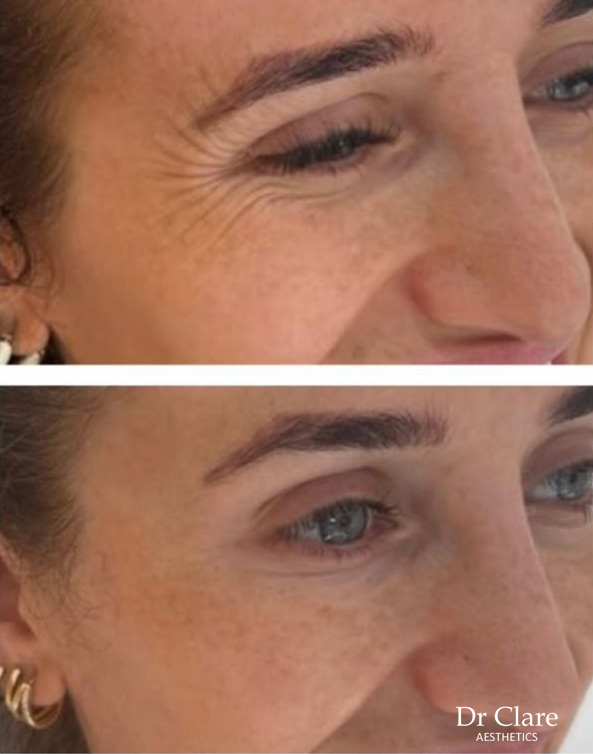 Expanded crow's feet anti-wrinkle result