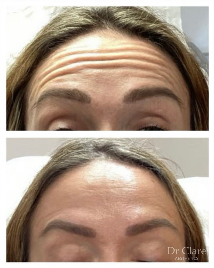 Forehead lines before and after anti-wrinkle treatment