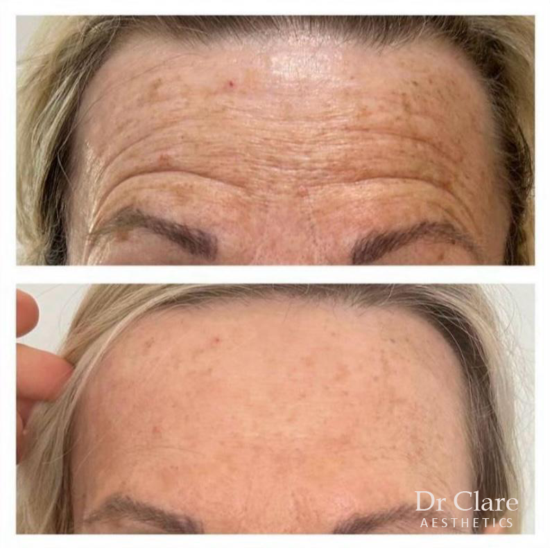 Forehead anti-wrinkle before and after result
