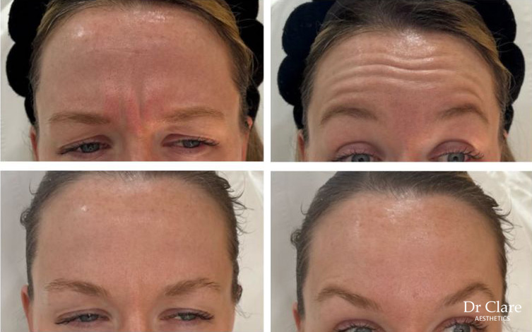 Forehead anti-wrinkle result with dark hair patient
