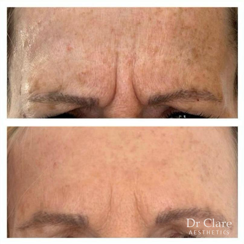 Frown line anti-wrinkle before and after