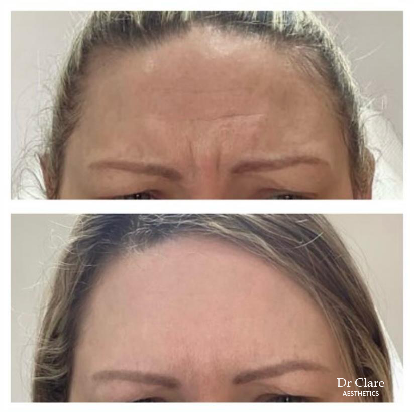 Frown line smoothing with anti-wrinkle treatment