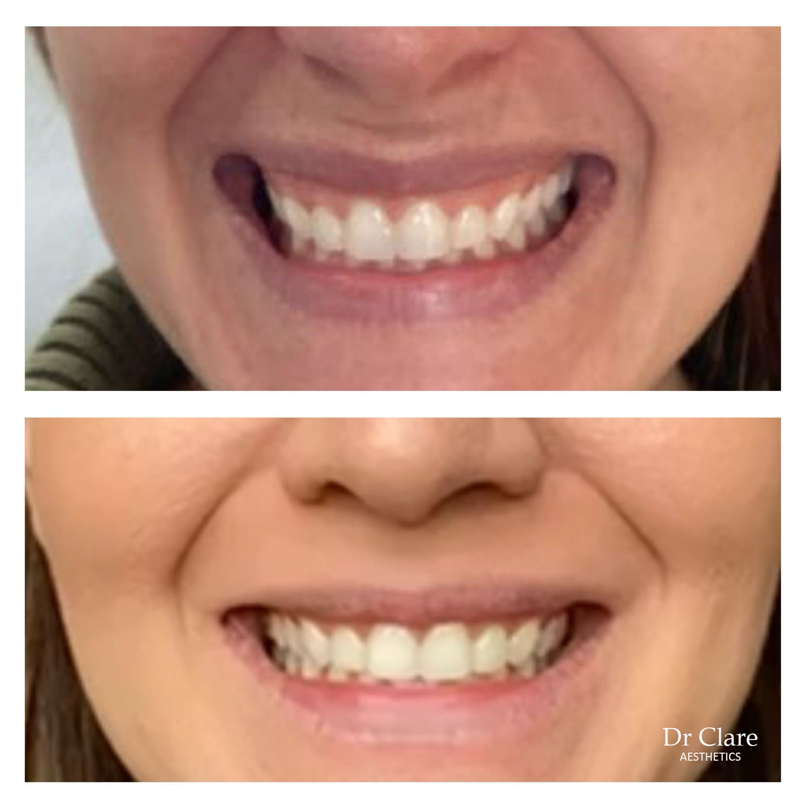 Gummy smile before and after anti-wrinkle treatment