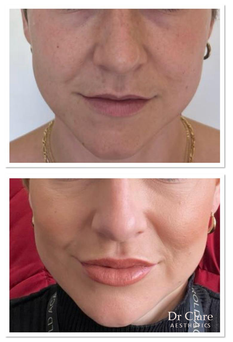 Cheek contouring filler result