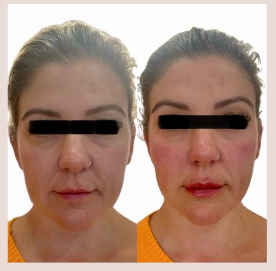 Chin filler before and after with front view