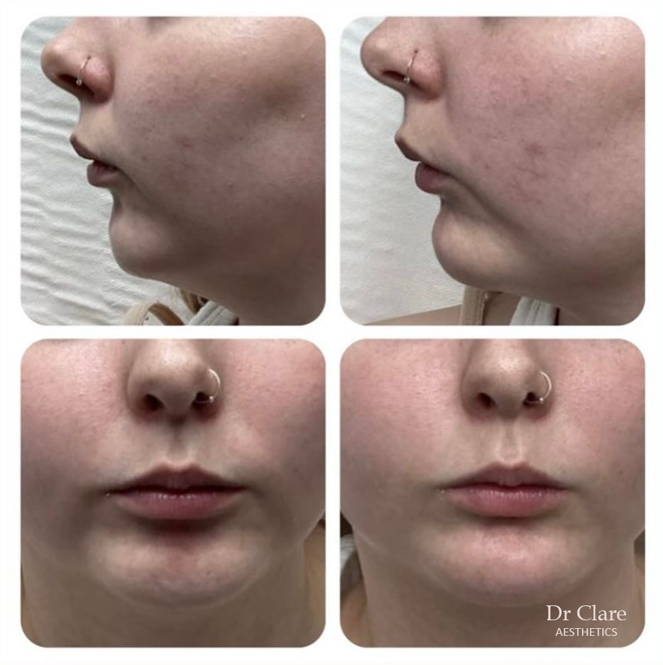 Chin enhancement dermal filler result