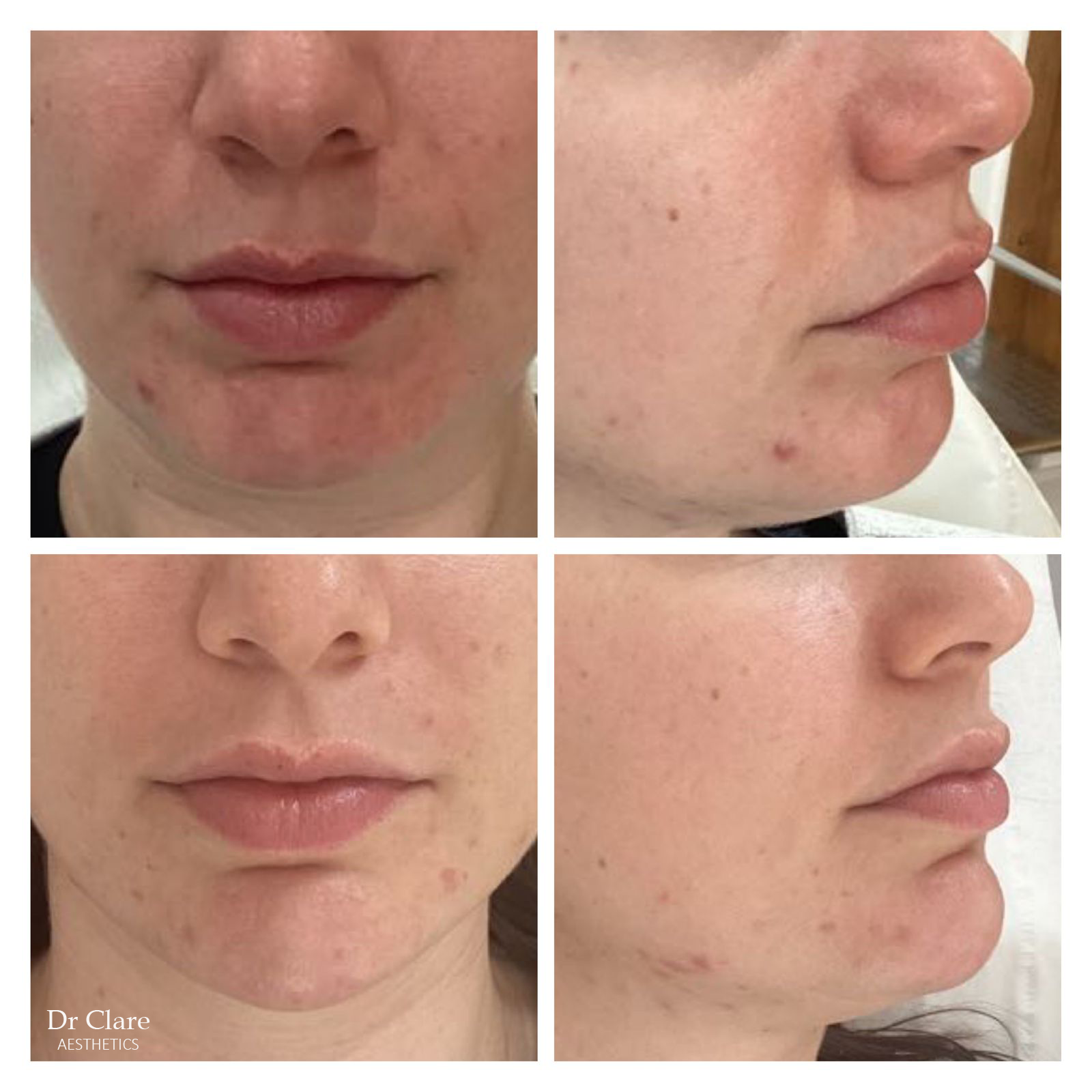 Chin profile balancing with filler