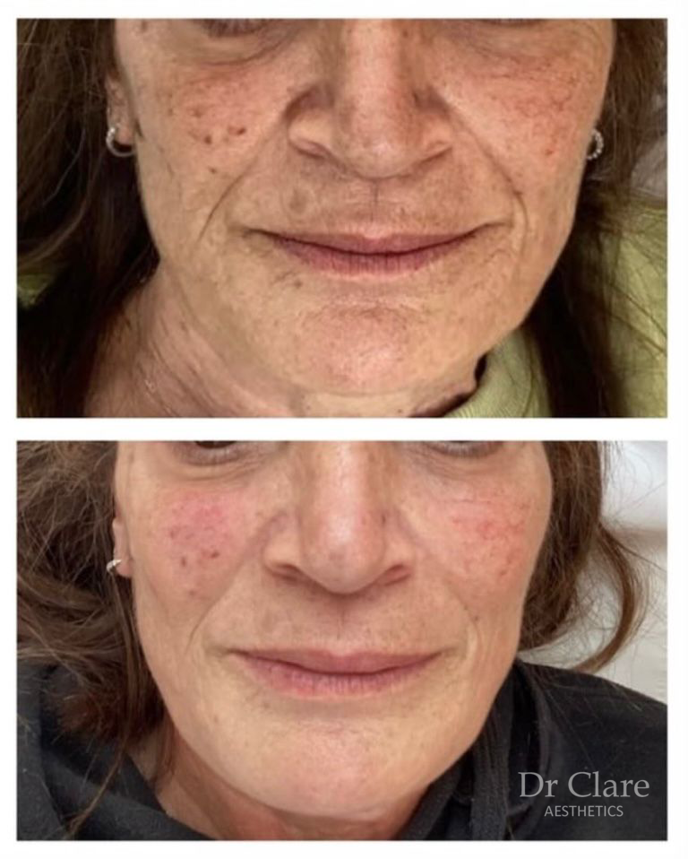 Dermal filler facial rejuvenation result