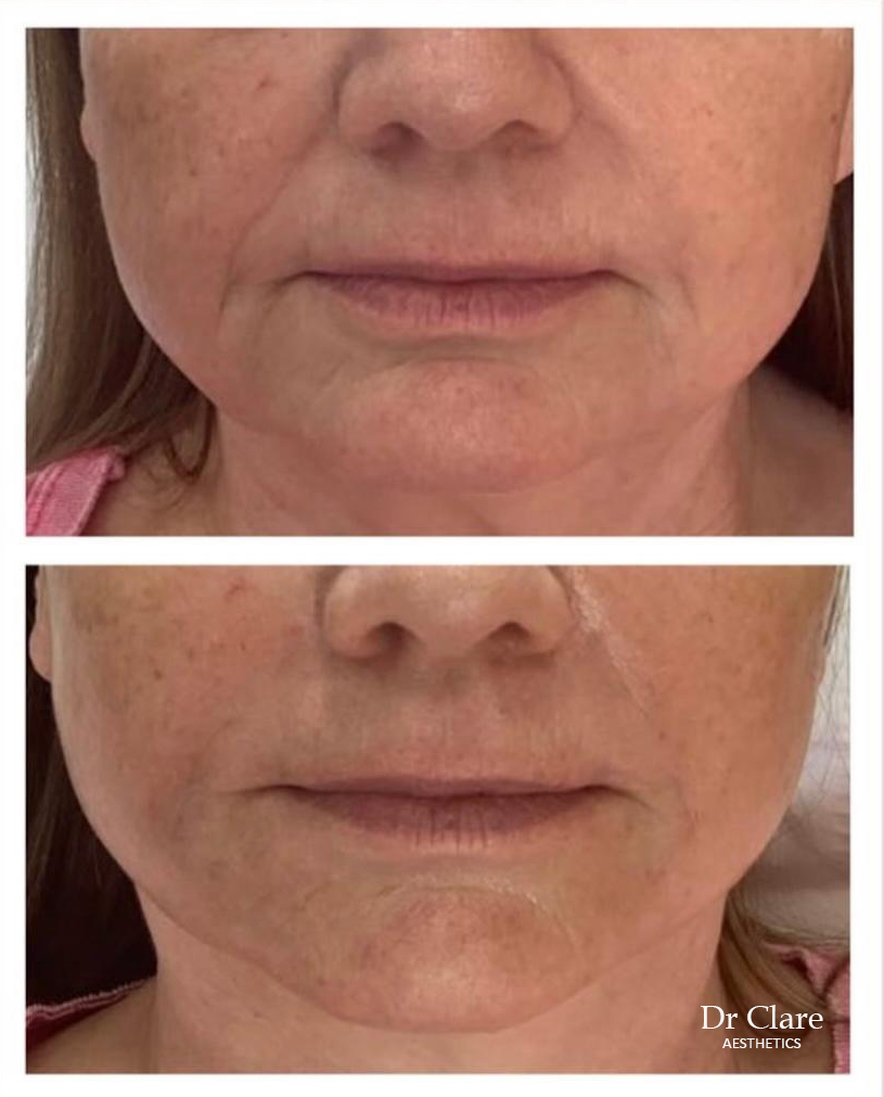 Dermal filler before and after for lower face support