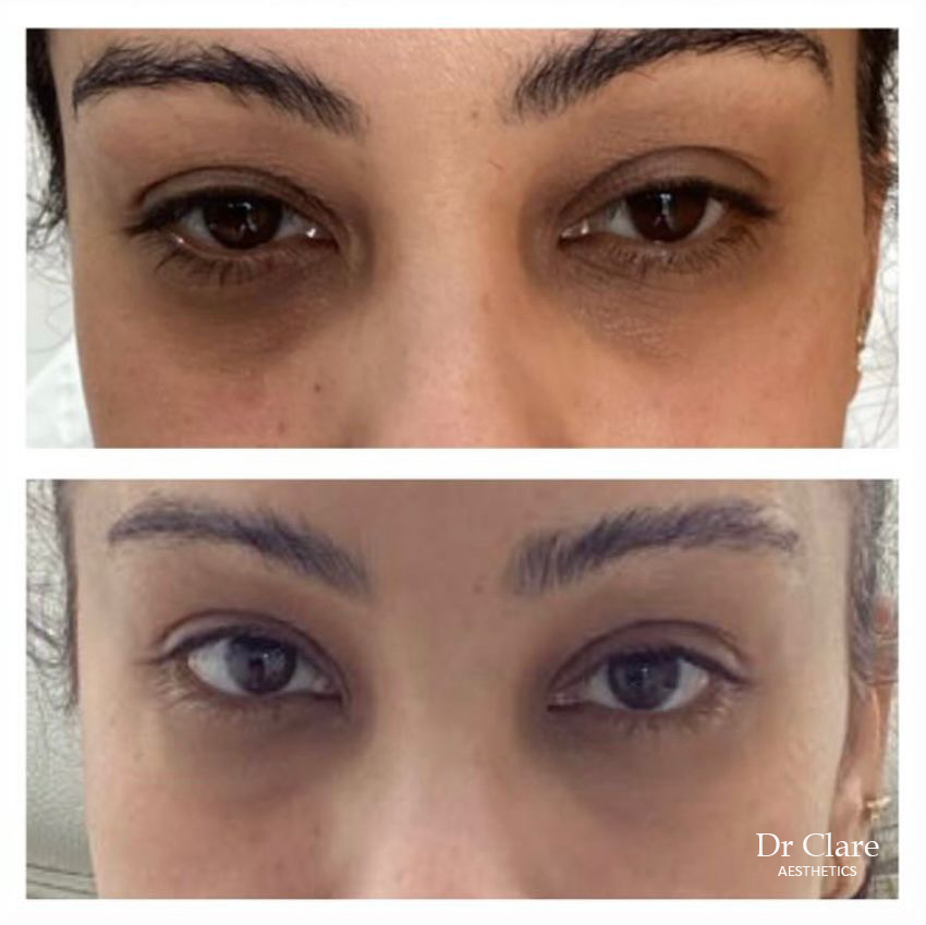 Tear trough filler before and after