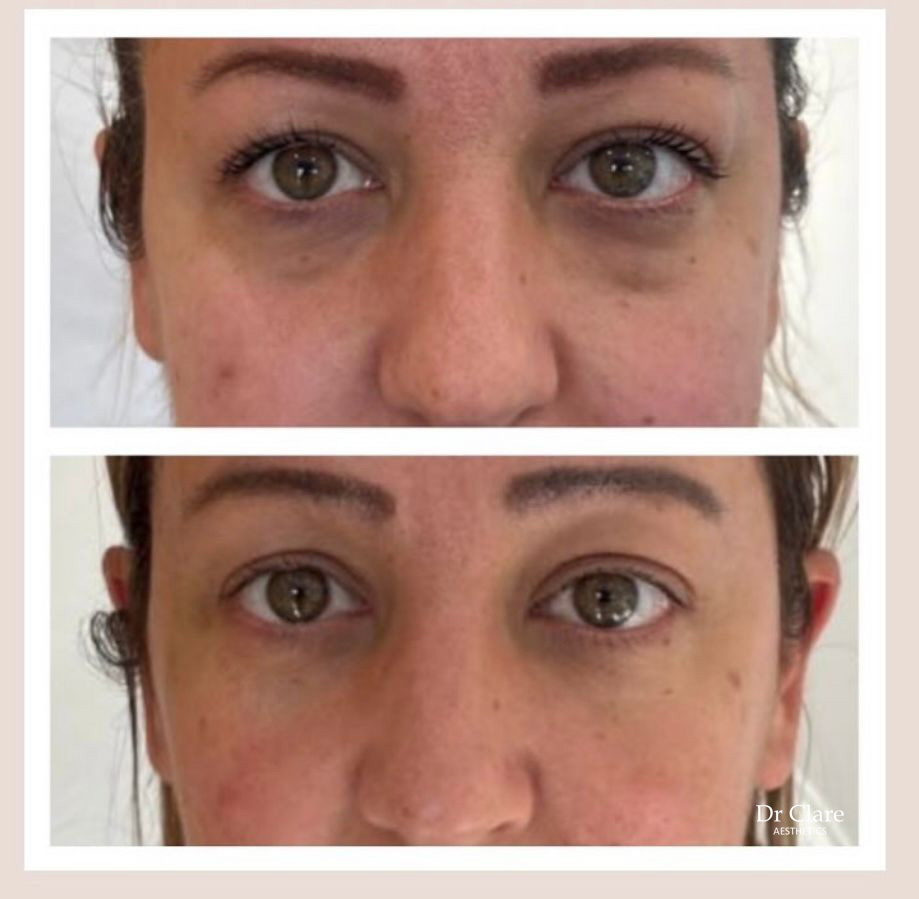 Expanded tear trough filler result