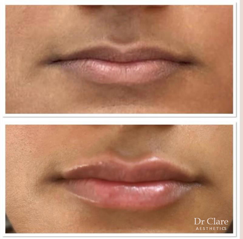 Lip border and volume enhancement result
