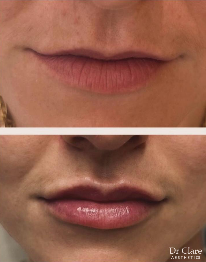 Lip filler before and after for definition