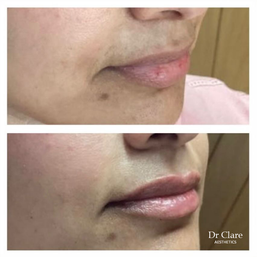 Natural lip enhancement before and after