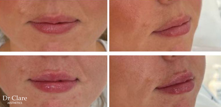 Expanded lip enhancement result with front view