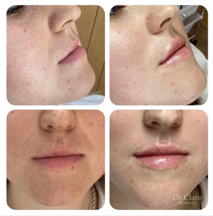 Lip filler shape and volume result