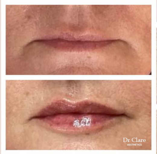 Lip enhancement before and after with natural volume