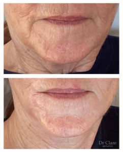 Dermal filler treatment result