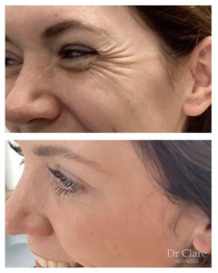 Anti-wrinkle treatment result 1