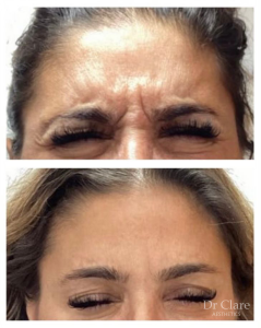 Anti-wrinkle treatment result 2