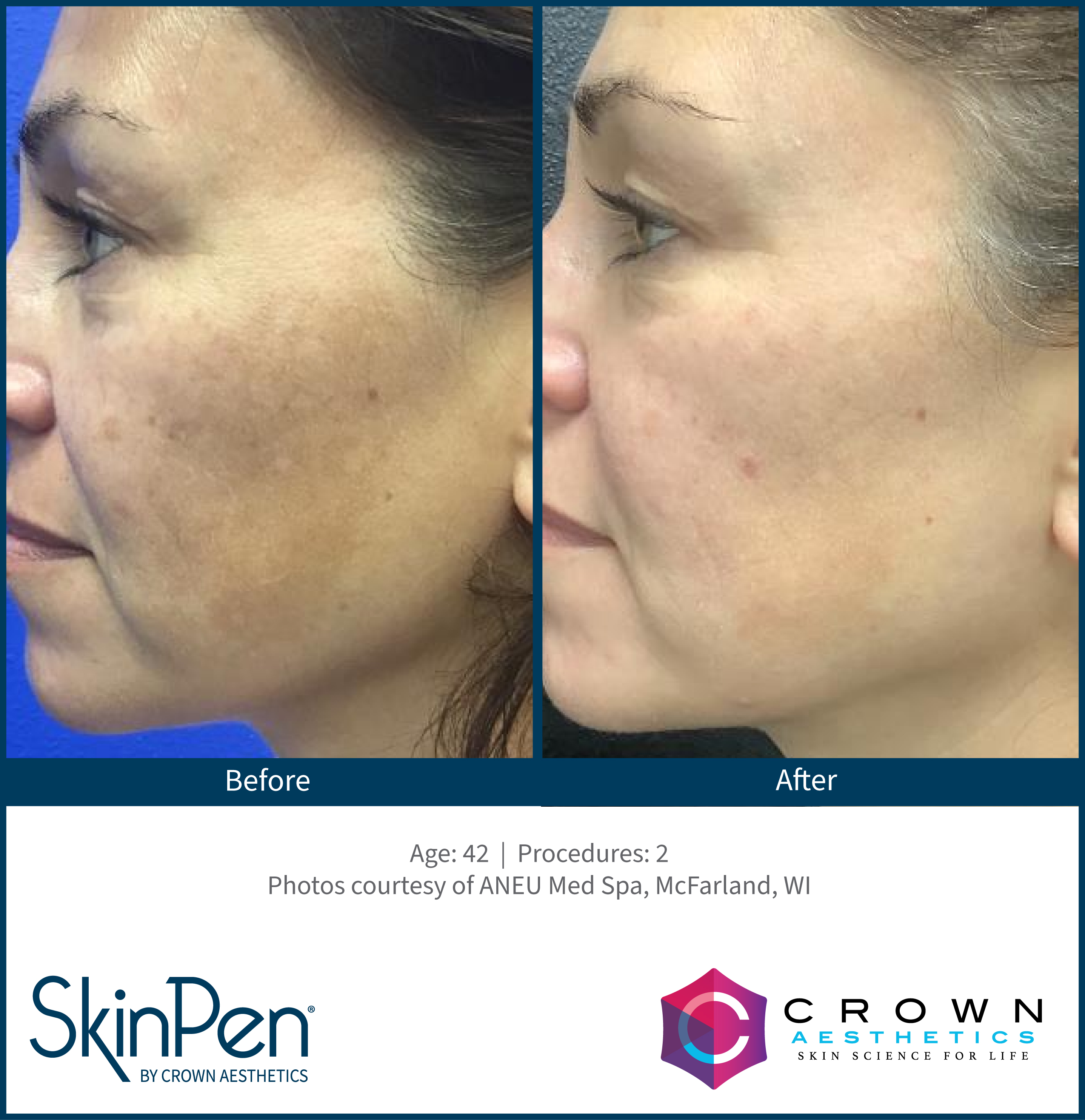 SkinPen sun damage improvement result