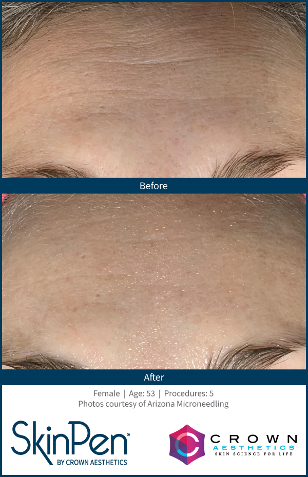 SkinPen forehead texture improvement