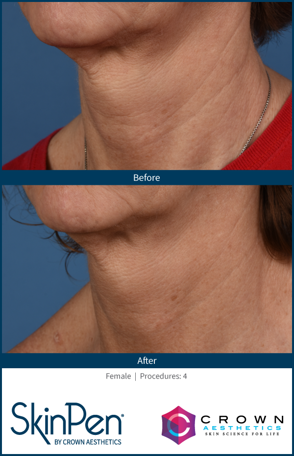 SkinPen neck rejuvenation before and after