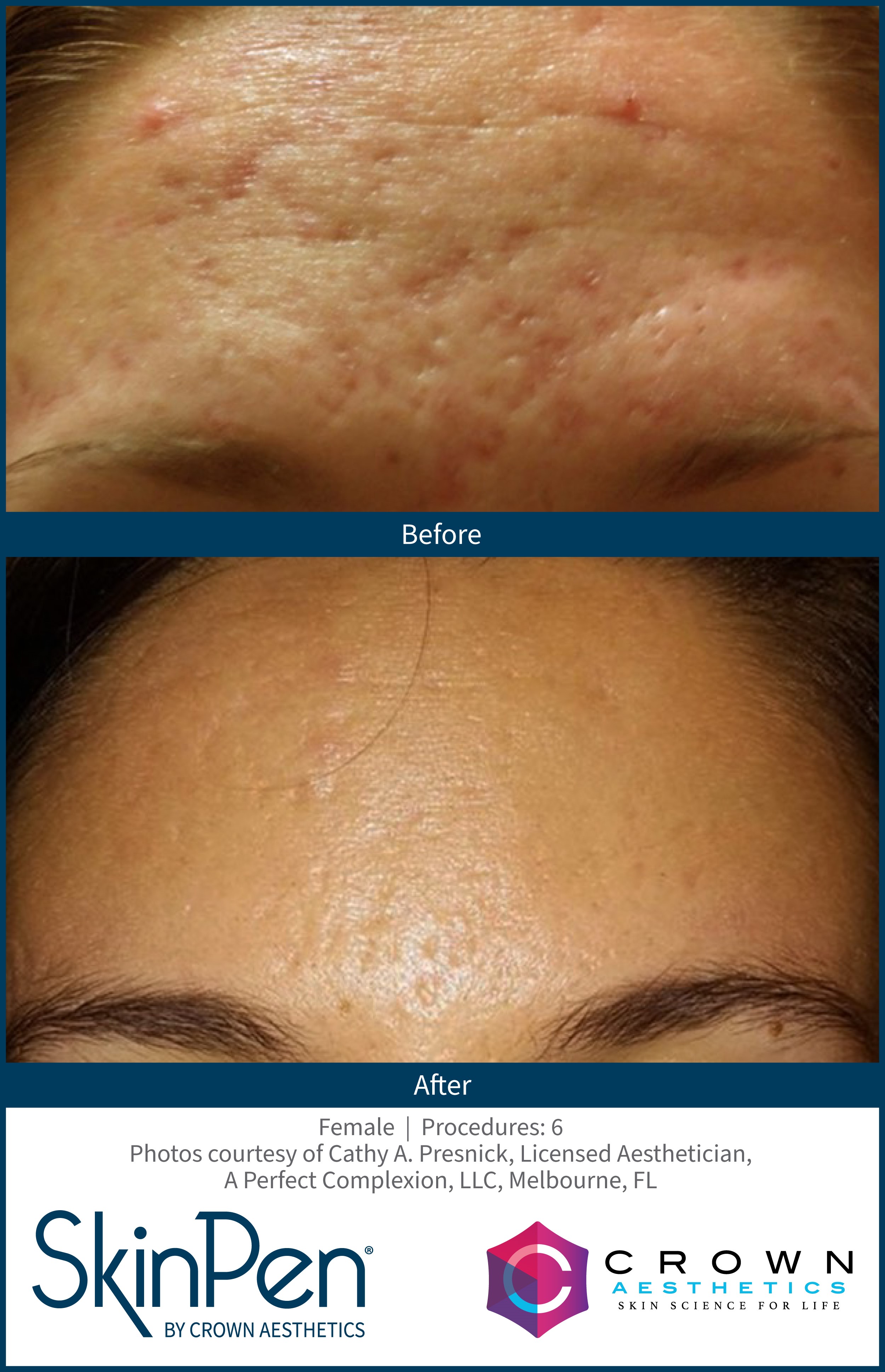 SkinPen acne scarring result example