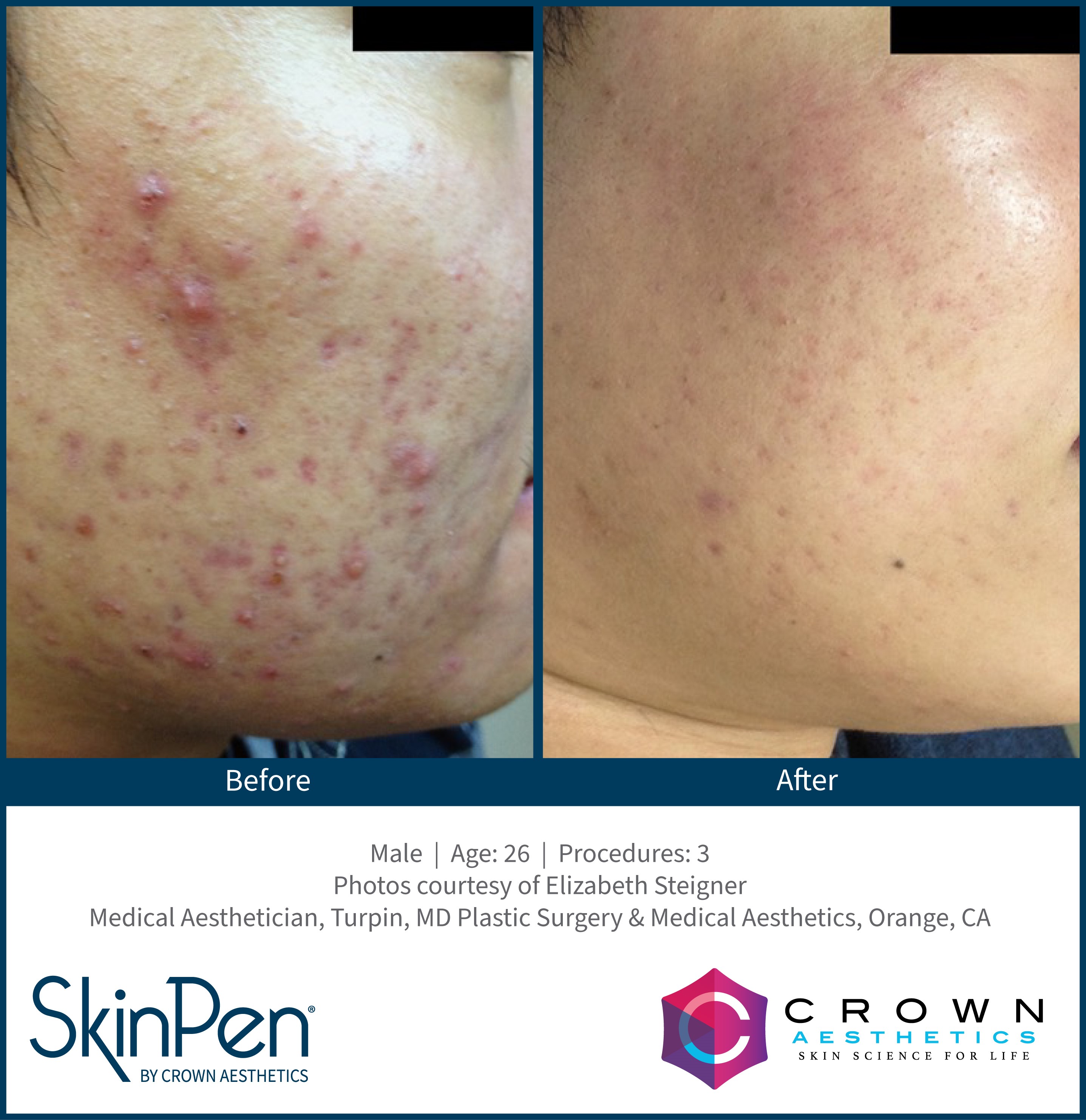 Microneedling acne scar improvement
