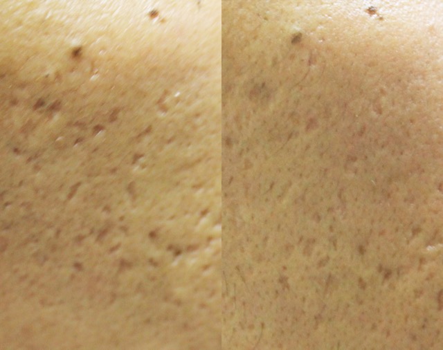 Male acne scarring before and after SkinPen