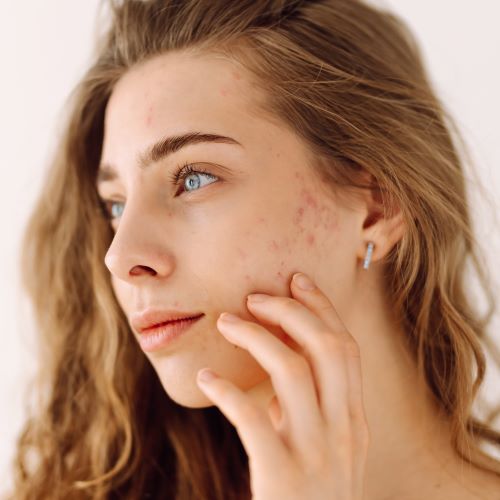 Acne polynucleotide treatment area