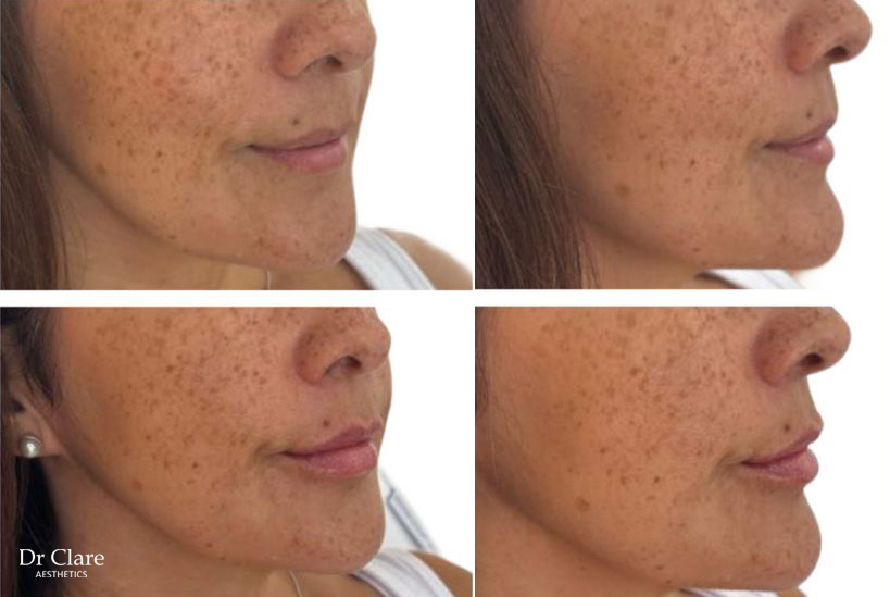 Lips before and after