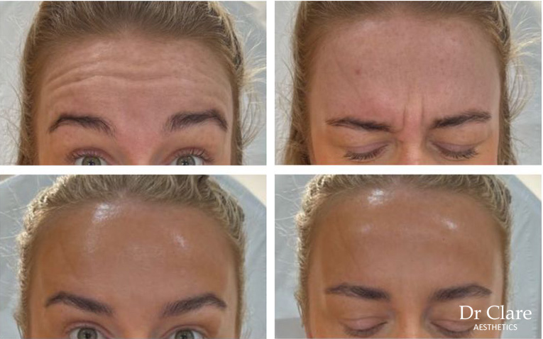 Anti-wrinkle forehead lines before and after