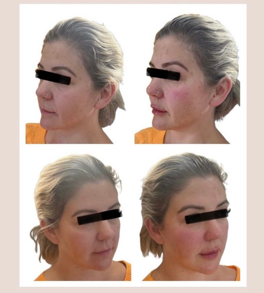 before and after cheek treatment