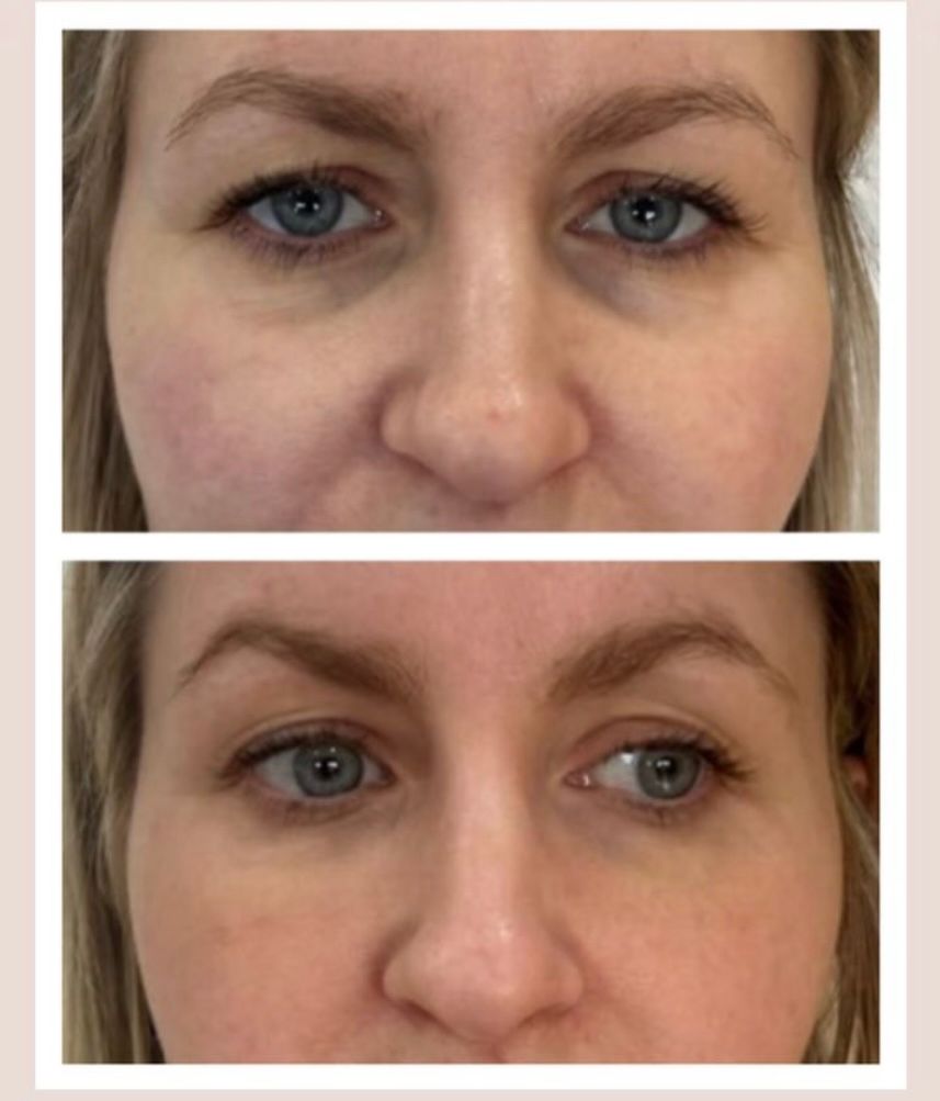 before and after tear trough filler